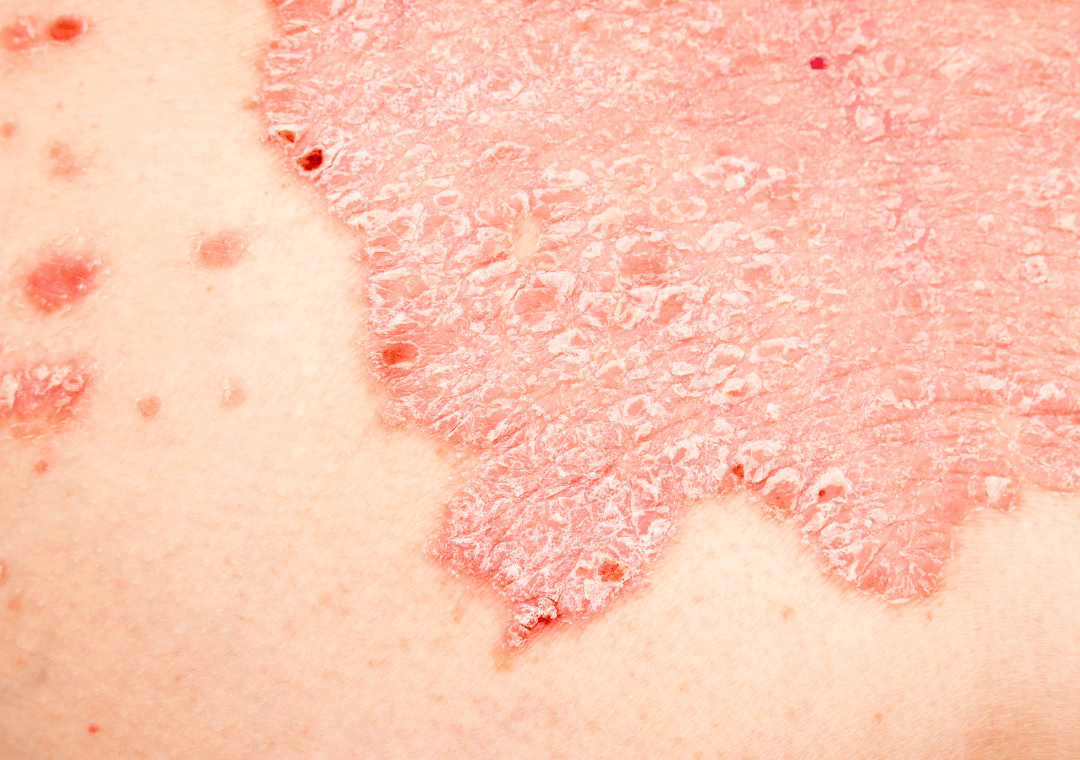 Para que sirve la crema de CBD 1 cbd y psoriasis